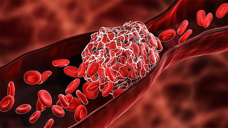 Blood Clotting Disorders Types, Symptoms, Diagnosis, And Treatment